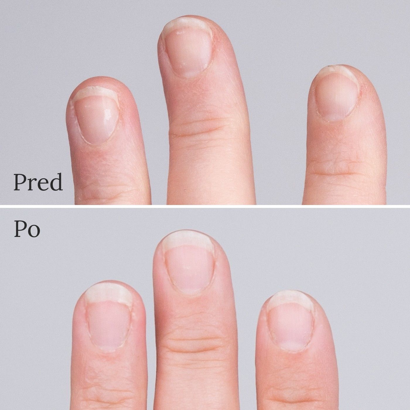 Nechty pred a po 3 mesiacoch užívania vitamínového komplexu deNatura.